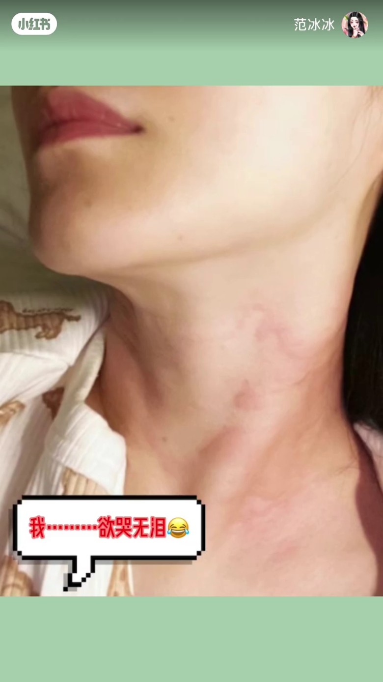 飞韩国拍剧皮肤严重过敏 范冰冰公开烂脸照:我很害怕
