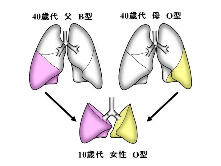 全球首例!不同血型肺部移植成功 日本B型爸捐肺给O型女儿