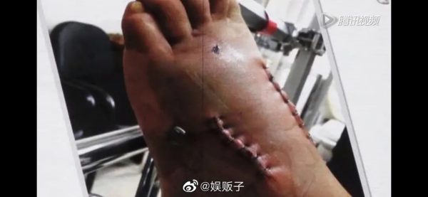 黄晓明自爆左脚植钢钉 全是劣质钢丝惹祸!
