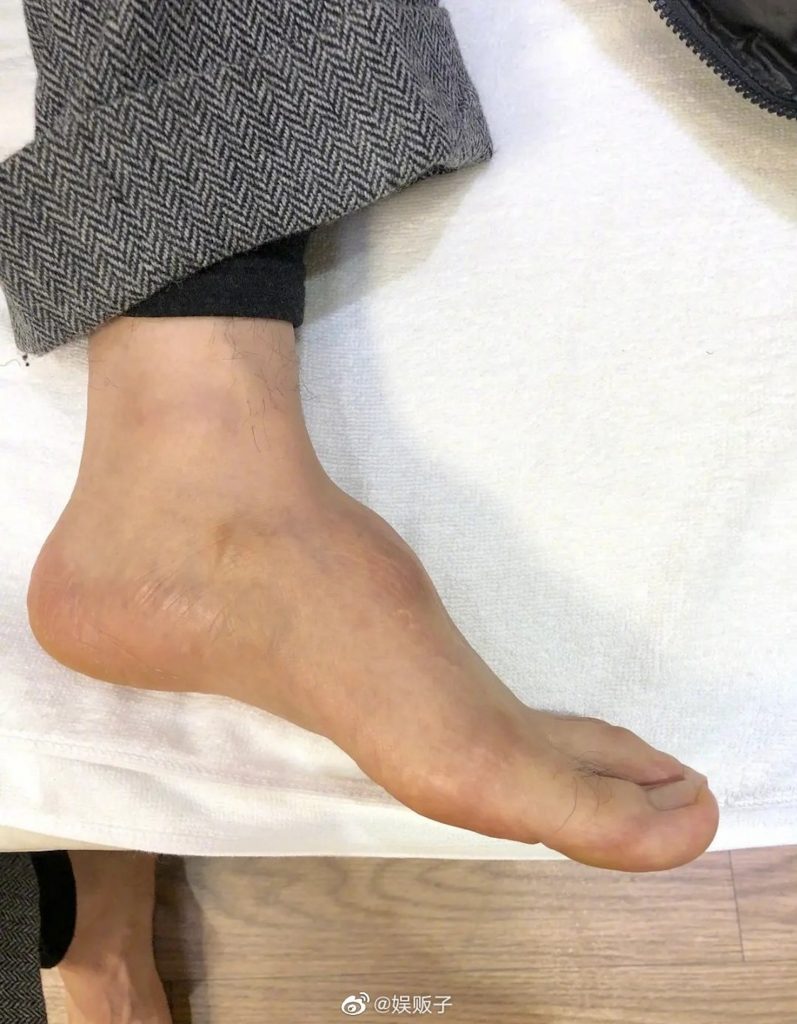 黄晓明自爆左脚植钢钉 全是劣质钢丝惹祸!
