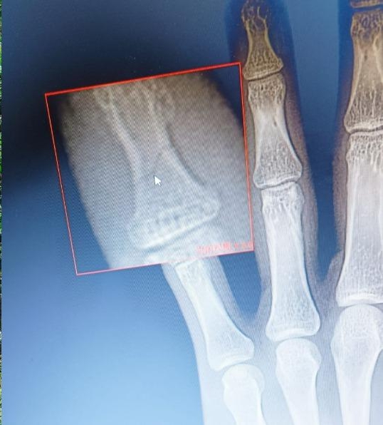 萧敬腾骨裂肌肉恐萎缩 坚持不打钢钉原因曝光