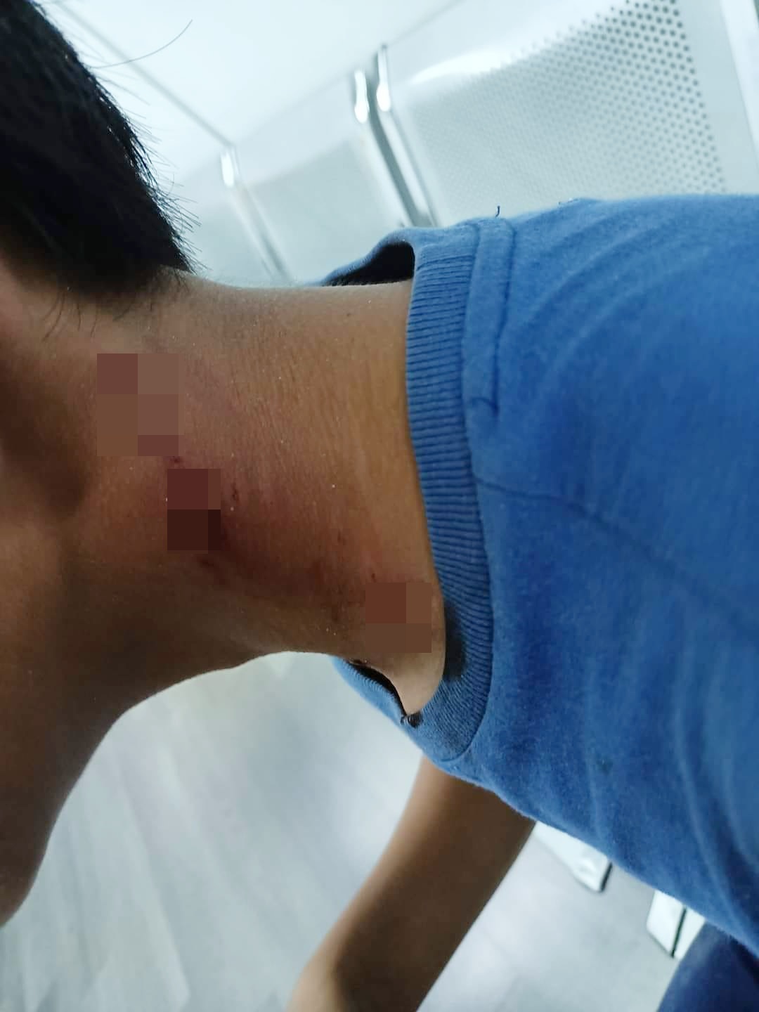 (全国版)邻居家犬咬伤男童,童父:邻居付20令吉打发