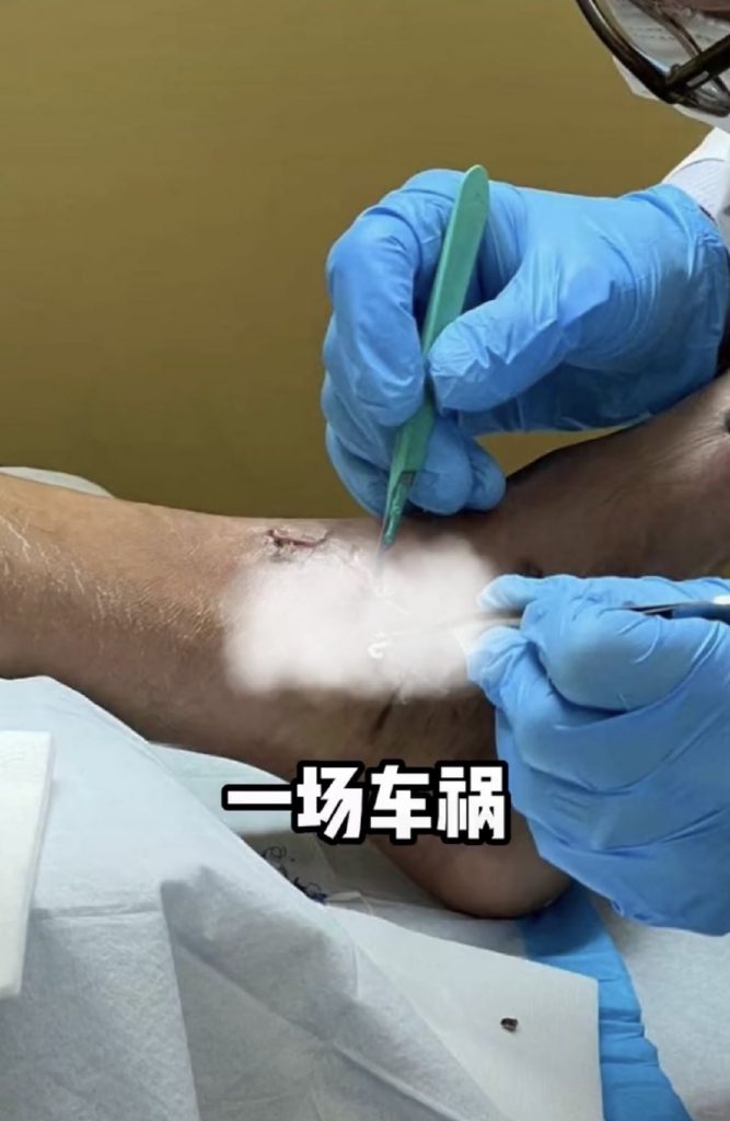 陈学冬出严重车祸 左腿肌肉萎缩坐轮椅