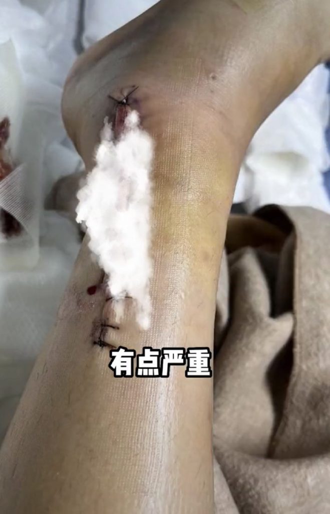 陈学冬出严重车祸 左腿肌肉萎缩坐轮椅