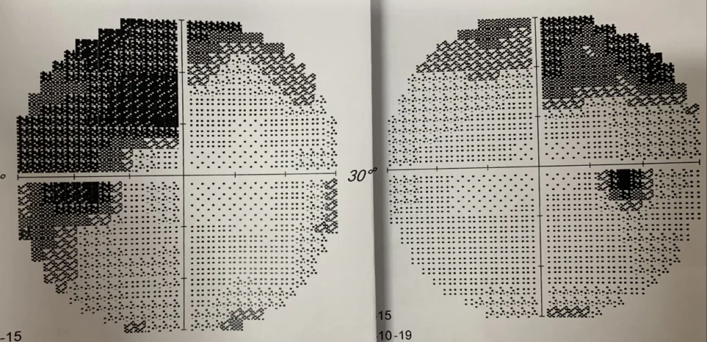 盛晓峰/月事失调 视力缺损 常昏厥 原来垂体大腺瘤作怪