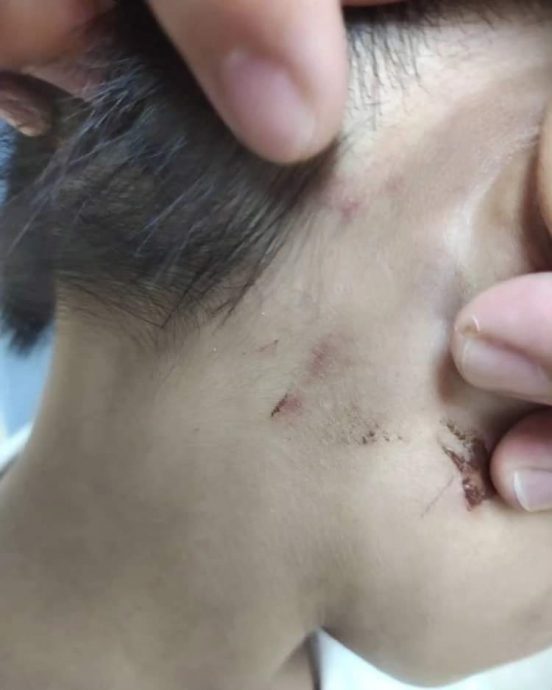 6岁男童疑被生母和男友虐待送院,2涉案者皆已落网