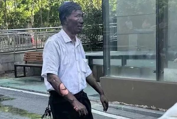 拼盘/70岁老伯冲火场变“黑面雕像” 手臂皮肤被烧掉一大块