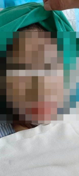 19岁少女惨遭泼酸 两个月动刀8次换肤救眼