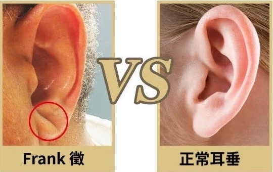 看耳垂知心脏?