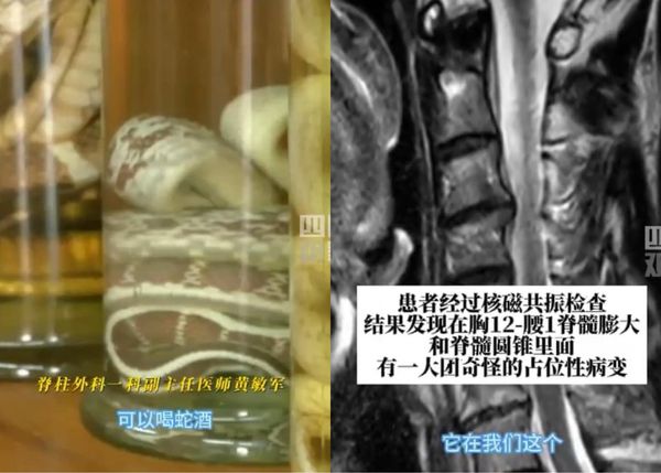 男子“吞蛇胆喝蛇药”15年后怪病缠身 医吓:寄生虫爬满脊髓