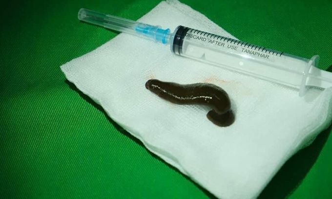 男子喉间异物蠕动 入院检查抓出6cm活水蛭!