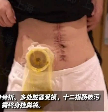 家暴16次 中国女子“终身挂粪袋”还离不了婚