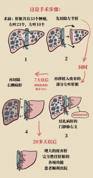 “废弃肝”变“救命肝” 上海完成全球首例“废弃肝”ALPPS手术