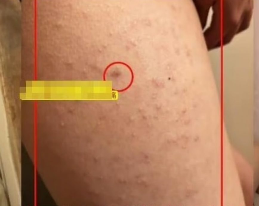 小女生大腿遭同桌男生扎218针 校方竟称“不符合霸凌标准!”