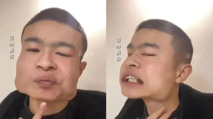 拼盘∕18岁少年嚼槟榔8年瓜子脸吃成“iPad” 网惊:以为特效