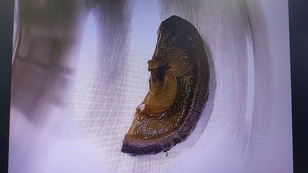 拼盘∕未咬碎吞下 5公分香菇卡小肠男子挨刀