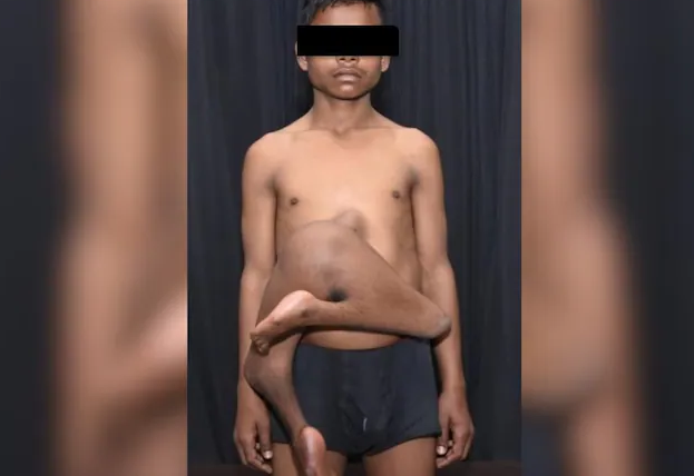 肚子多长一双腿!印度17岁少年“寄生双胞胎”附在胸骨上