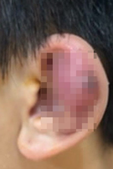 爱美男耳垂耳骨打洞 手痒一直摸耳洞生脓!
