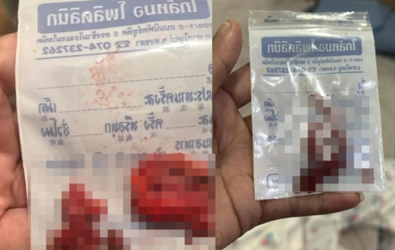(有视频)取出脸部整形填充物 艺人妻子鼻梁下巴变歪