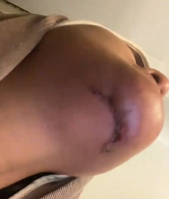 (有视频)取出脸部整形填充物 艺人妻子鼻梁下巴变歪