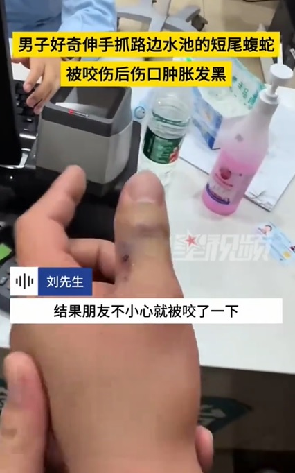 供Newswire:视频|男子好奇抓短尾蝮蛇被咬 手肿胀发黑急送医