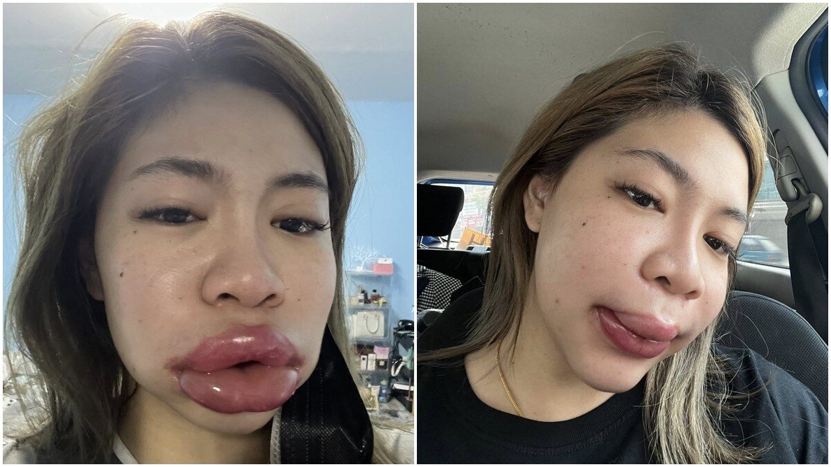 美了还要更美 女子注射玻尿酸 唇肿如香肠