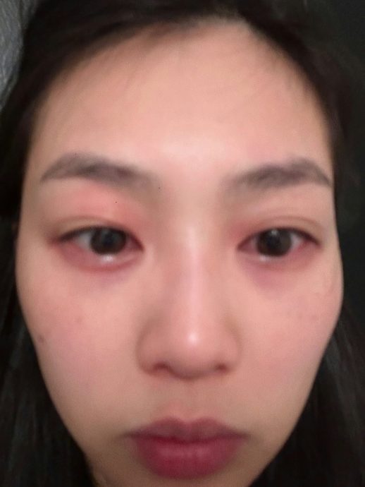 郭柏妍食物敏感眼部红肿 气管收缩:喘不过气