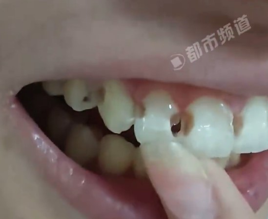 5年牙套竟换来8颗蛀牙!医生一听她的刷牙方式直摇头