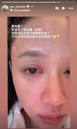 陈乔恩眼角异常红肿 忍了嘴馋拯救健康