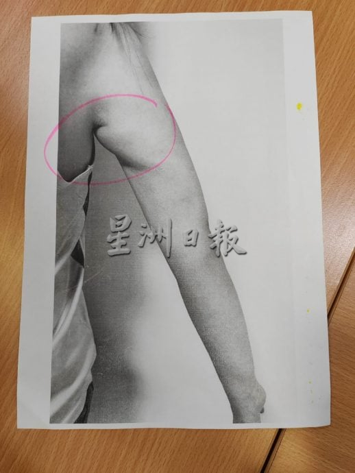 已签发//轻信网红广告做抽脂手术·女子术后不适 惊揭“医疗团队是外国人”