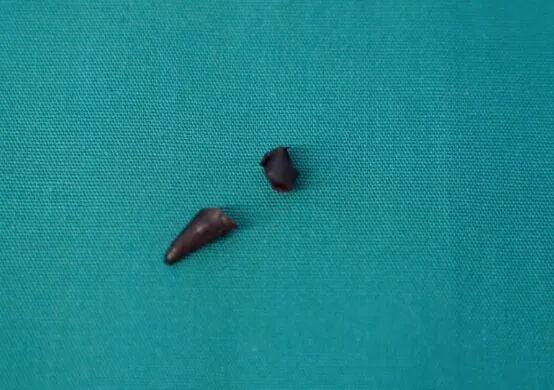 七旬男体检误诊“肺癌” 医生切开发现是辣椒尖