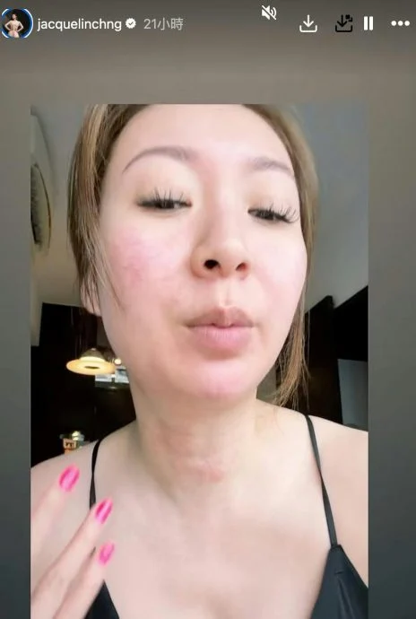 脸颈惊爆出严重红疹 庄思敏:好痛苦啊!