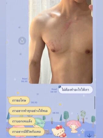 BL剧男星被指控劈腿家暴 男友晒胸口血痕照喊告