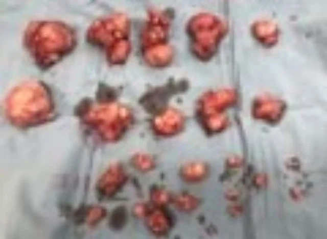 拼盘 42岁女误以为变胖竟取出50颗子宫肌瘤
