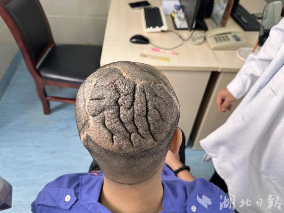 拼盘 小伙头皮褶皱如脑沟回 经11个月扩皮手术赢回自信