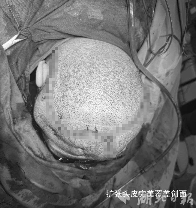 拼盘 小伙头皮褶皱如脑沟回 经11个月扩皮手术赢回自信