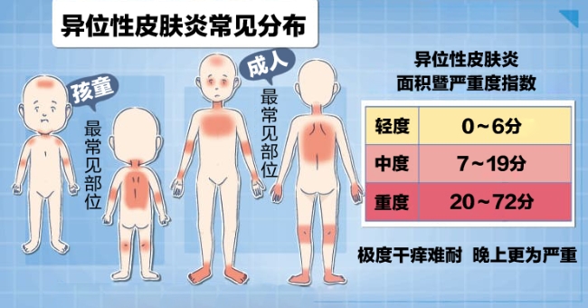 atopic dermatitis (2).jpg