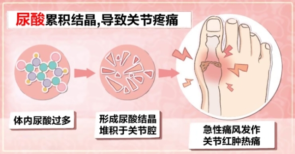 gout (2).jpg