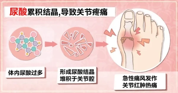 gout (2).jpg