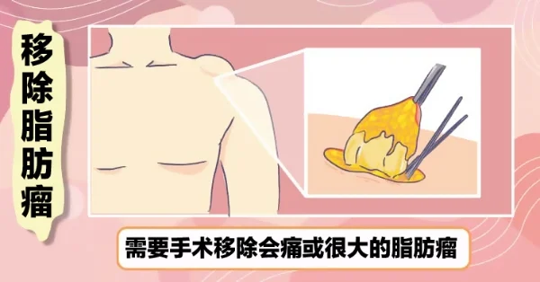 lipoma (4).jpg